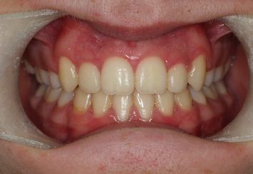 After - Orthodontics
