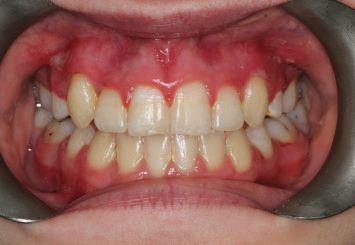 After - Orthodontics 