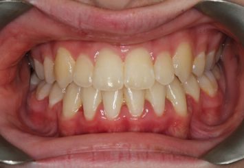 After - Orthodontics 