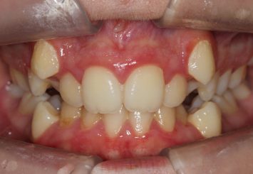 Before - Orthodontics