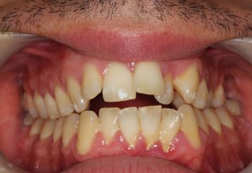Before - Orthodontics