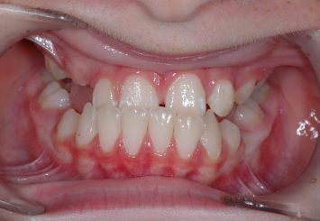 Before - Orthodontics